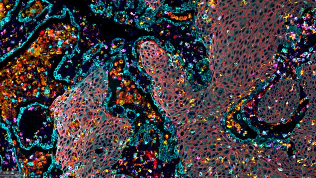 KRAS Inhibitor Daraxonrasib Shows Promise in Pancreatic Cancer